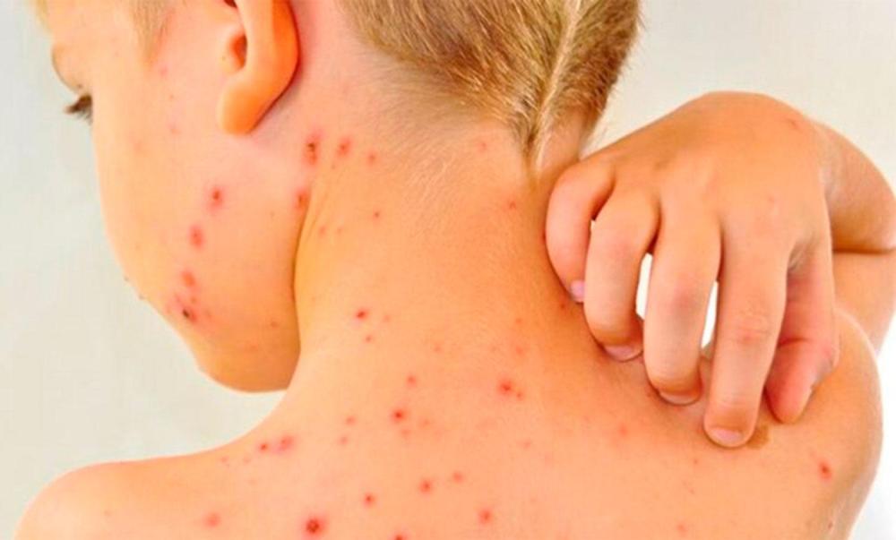 Alerta sarampión: qué es, cuáles son los síntomas y cuándo hay que vacunarse