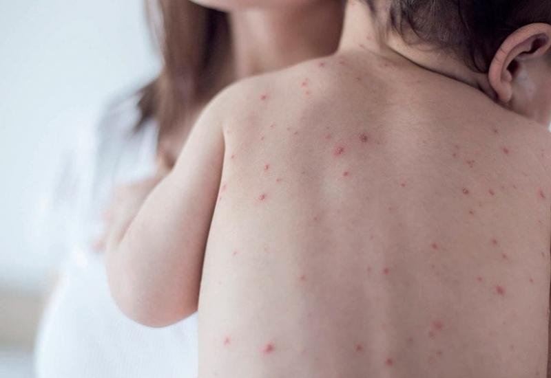 Sarampión en Argentina: llaman a completar el esquema de vacunación de los niños